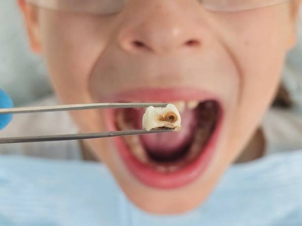Best Emergency Wisdom Teeth Removal in Mount Zion, IL